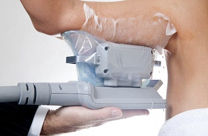 fat freezing arms Cambridge