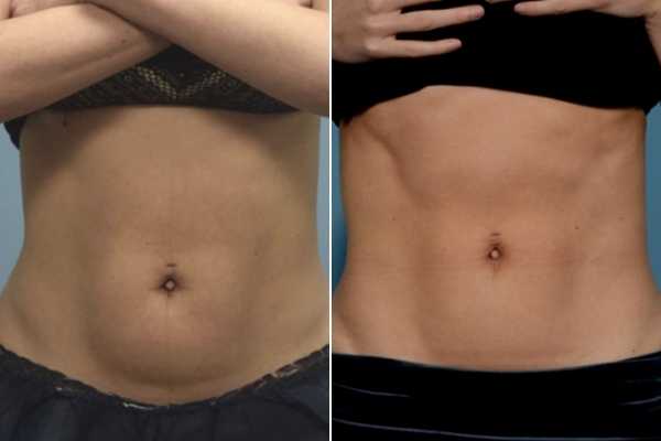 body sculpting FAQs Cambridge