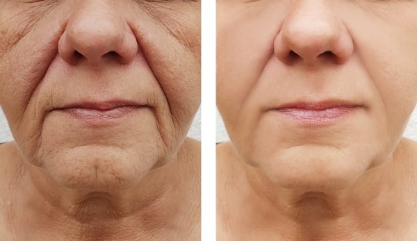 Learn more about Morpheus8 Treatment Cambridge today!