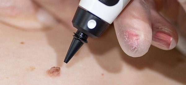 After Skin Tag Removal Cambridge