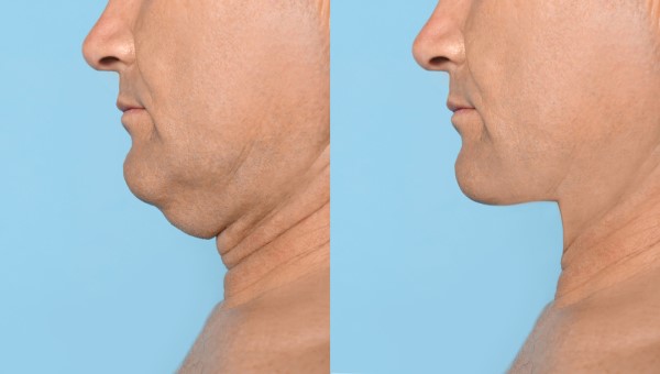 Which Non-Surgical Treatments Work Best for Jowls and Loose Skin Cambridge?