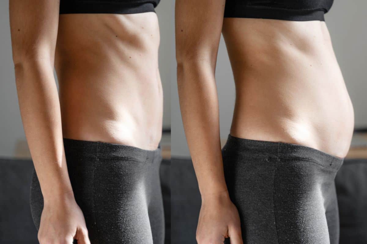 How long does diastasis recti take to improve Cambridge?