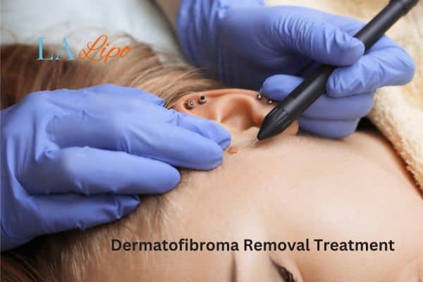 Dermatofibroma Removal Treatment Cambridge