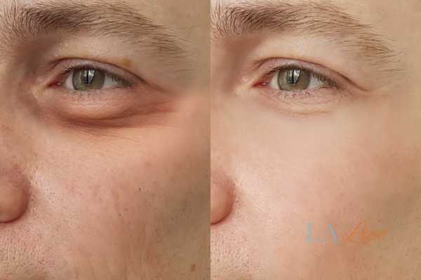 HIFU before and after