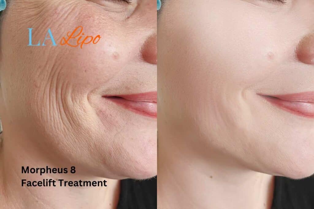 Morpheus8 Treatment Cambridge for flawless skin! Call us today!
