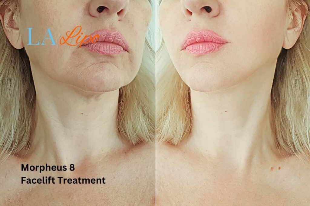 Turn back time with Morpheus8 Treatment Cambridge