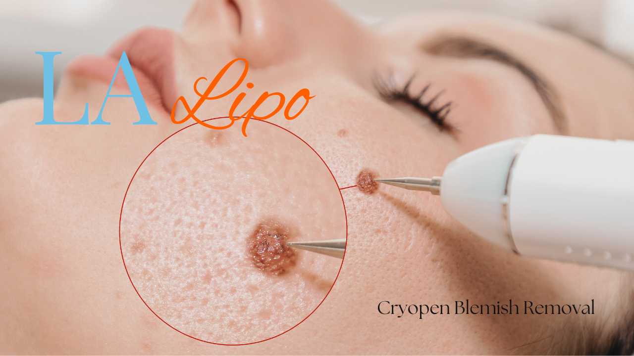cryopen blemish removal Cambridge Contact our team today!