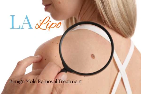 Woman having her inspection of blemish before mole removal Cambridge