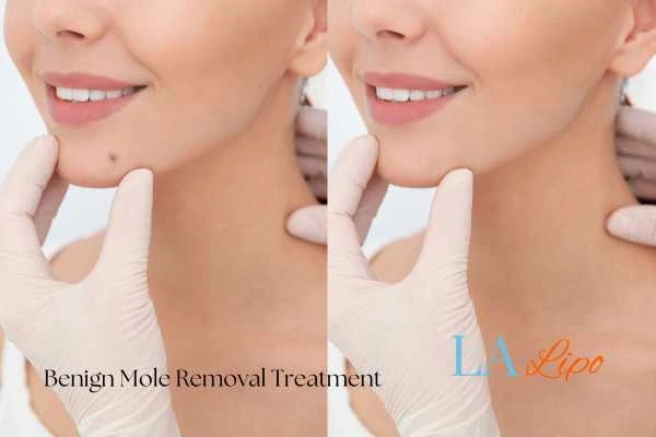 Before and after mole removal Cambridge treatment