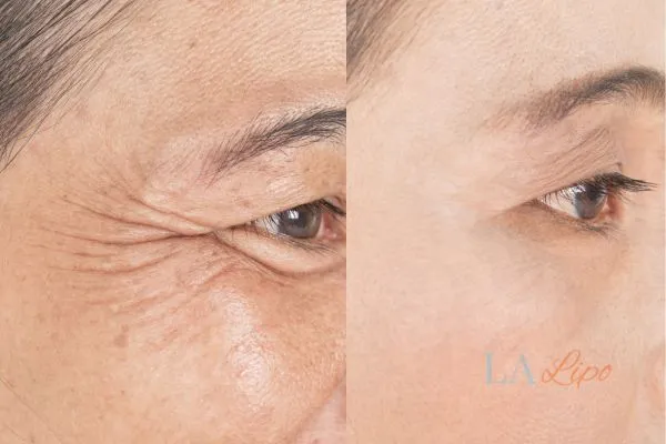 Before and after results of woman - HI-fu wrinkles reduction treatment Cambridge
