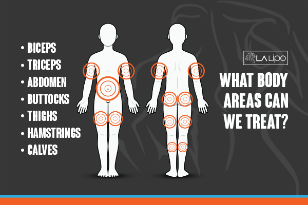 Graphic to show areas you can have LA-EMS Body Sculpting Cambridge treatment.