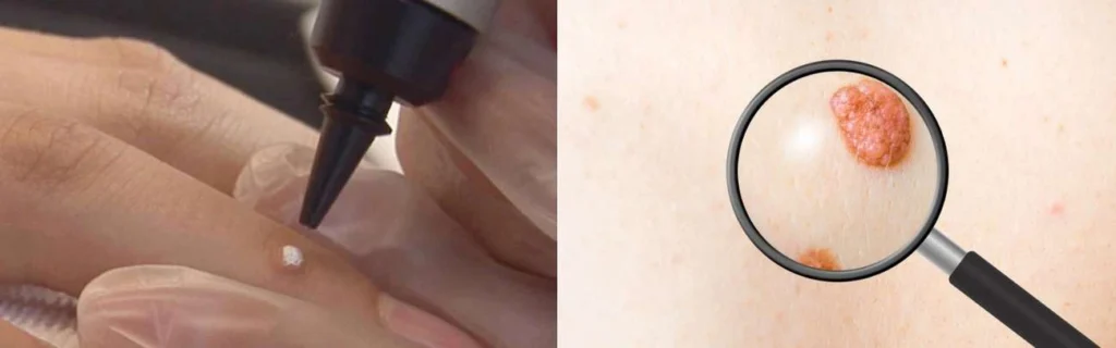 CryoPen practitioner Cambridge assessing a benign mole before treatment