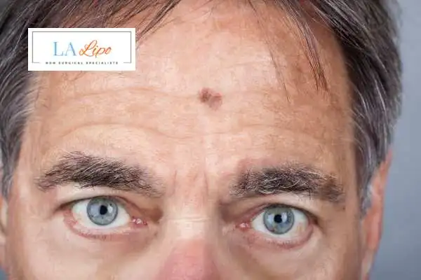 Solar Lentigo Removal Cambridge image of man with mark on his forehead