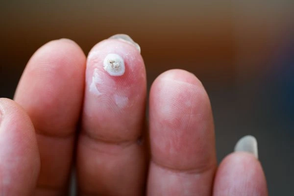 wart on person finger - cryotherapy to treat from LA LIPO Cambridge