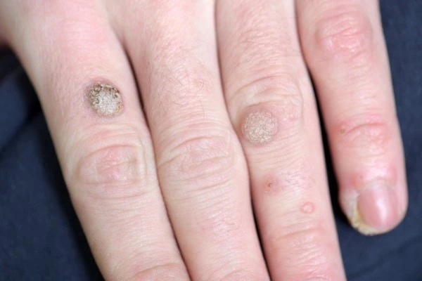 photo of warts on person hand - see wart removal Cambridge from LA LIPO