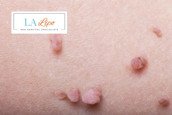 Does cryopen skin tag removal Cambridge hurt? Find out now call our team today!