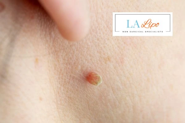 Book skin tag removal Cambridge today speak to our team now!