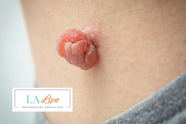 Interested in skin tag removal Cambridge? Concerned about the pain? Find out more today!