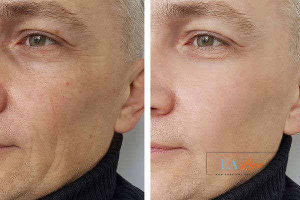 See the amazing results of Morpheus8 Treatment Cambridge!