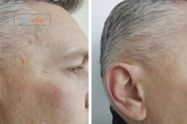Mens Before & After Morpheus 8 Results Cambridge