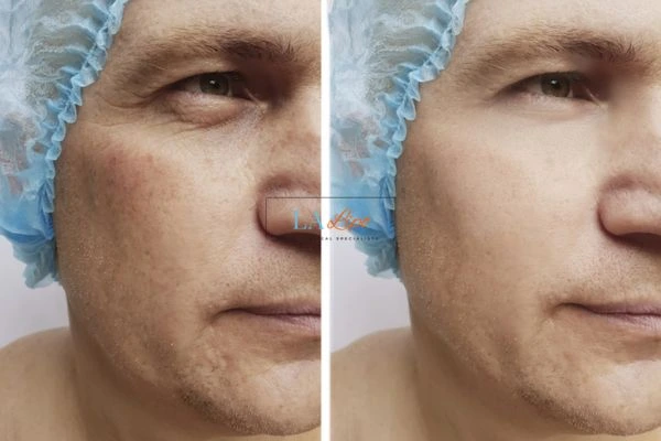 Before and after Morpheus 8 Results Cambridge