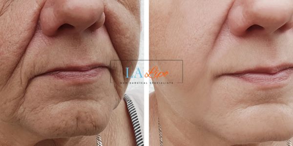 Older lady deeper wrinkle reduction - LA LIPO Morpheus 8 Results Cambridge