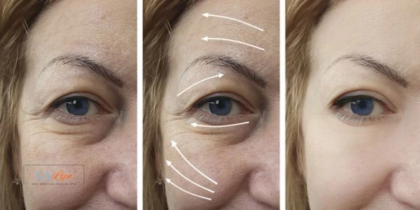 Amazing eye lift Morpheus 8 results Cambridge