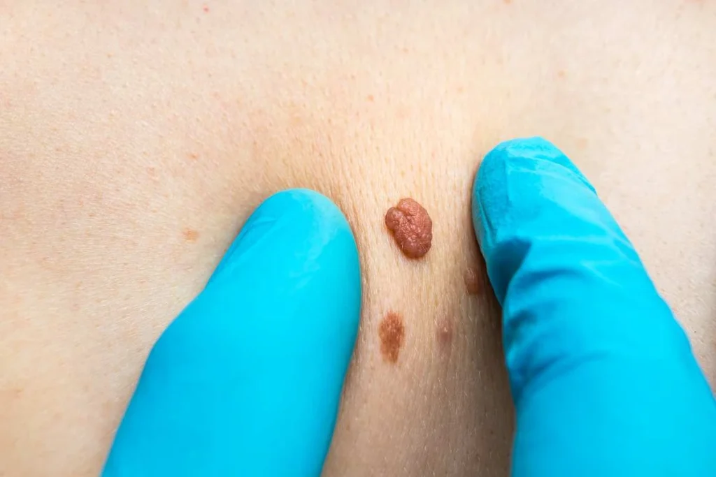 LA LIPO Cryopen Lesion Removal Prices Cambridge