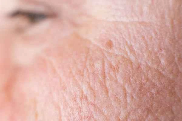 close up picture of a woman's face showing an age spot Cambridge
