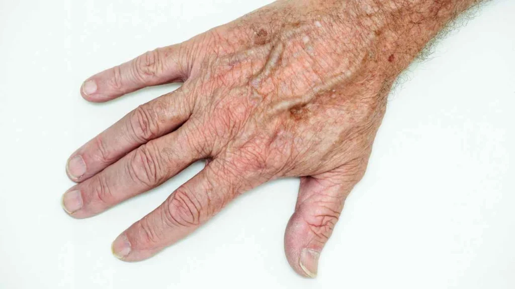 Male hand showing age spot Cambridge