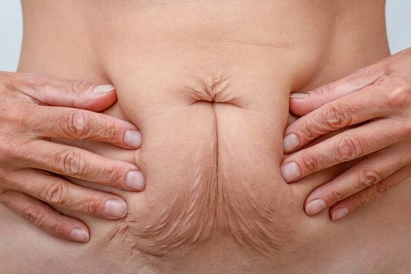 Image of a woman's stomach with loose skin - example of skin tightening Cambridge options