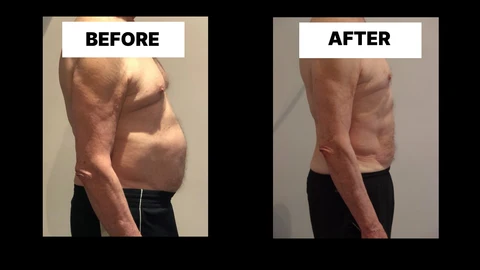 What Symptoms Can Diastasis Recti Cause in Men? Weak Core, Back Pain and Poor Posture Cambridge